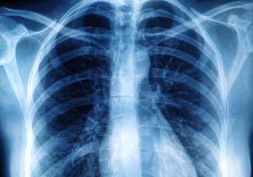 Qual é a relação entre fibrose pulmonar e refluxo gastroesofágico?
