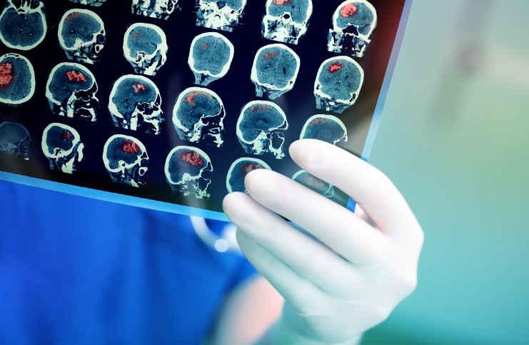 AVC isquêmico: escore PREMISE é confiável na previsão do risco de morte?