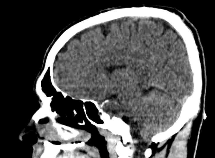 Veja o que você precisa saber sobre cordomas de base de crânio