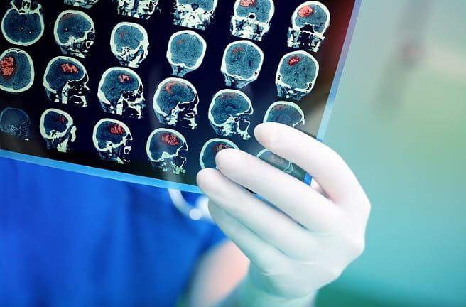AVC: o que muda com as novas recomendações do guideline?