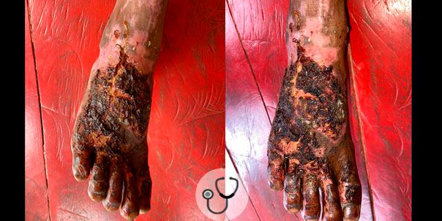 Caso clínico: queimadura em paciente de comunidade ribeirinha