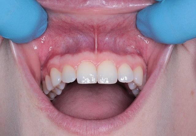 Disbiose e doenças da cavidade oral