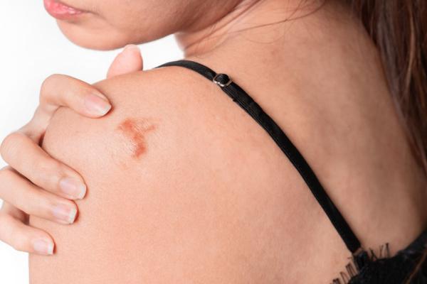 Avanços no tratamento de cicatrizes hipertróficas e queloides