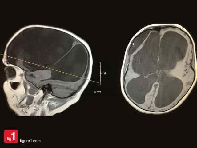 Hidrocefalia na criança: como manejar?
