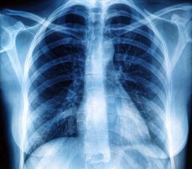 GOLD atualiza suas diretrizes para o manejo da doença pulmonar obstrutiva crônica; veja o que mudou