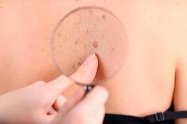 dermatologista examinando pinta de paciente