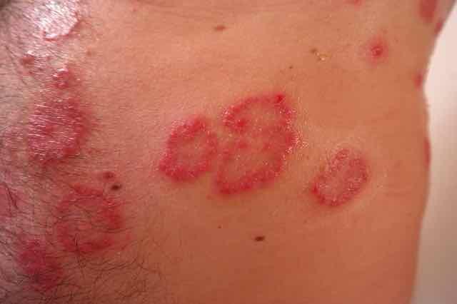 psoriase