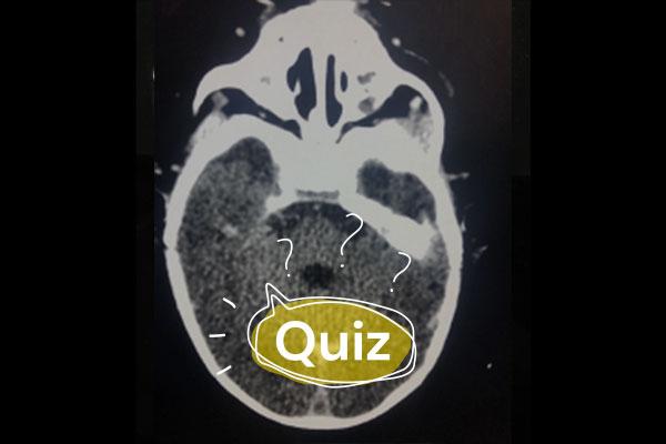 quiz-sepse -