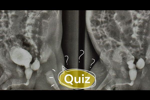 Quiz: Paciente recém-nascido com relato de hidronefrose. Qual o diagnóstico?