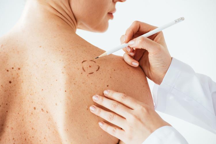 Médico avaliando lesões de pele suspeitas de melanoma em dorso de mulher.