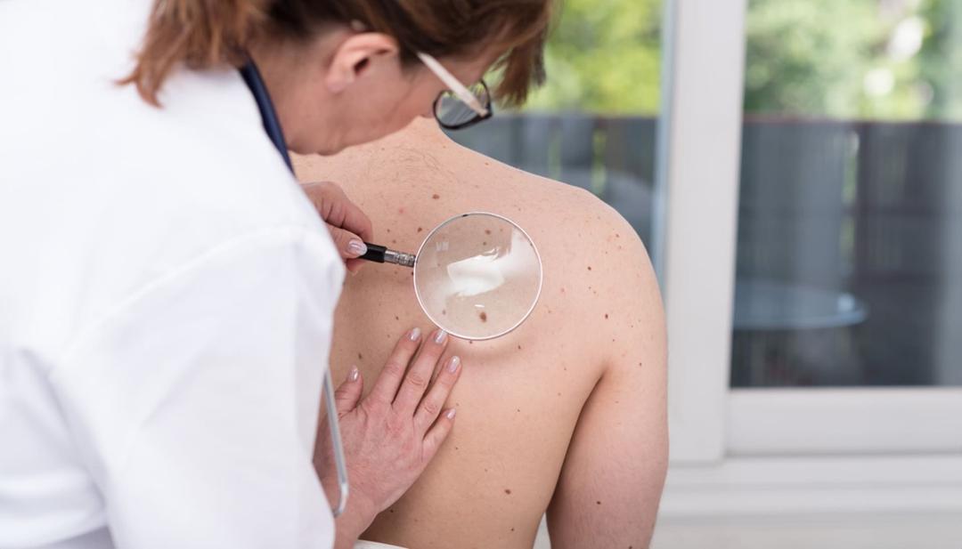 Dermatologista analisando placas eritematosas no dorso de paciente