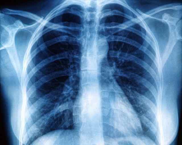 raio x do tórax