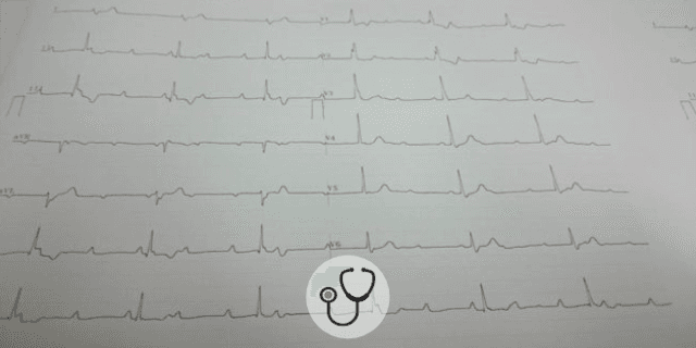 Caso clínico: qual o laudo do ECG e conduta?
