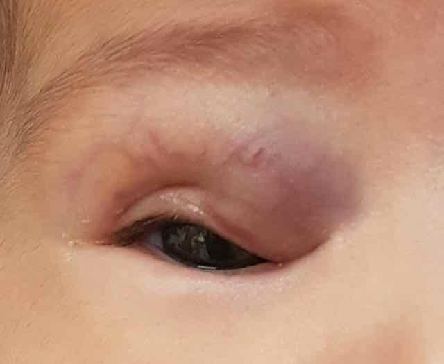 bebe com Hemangioma capilar