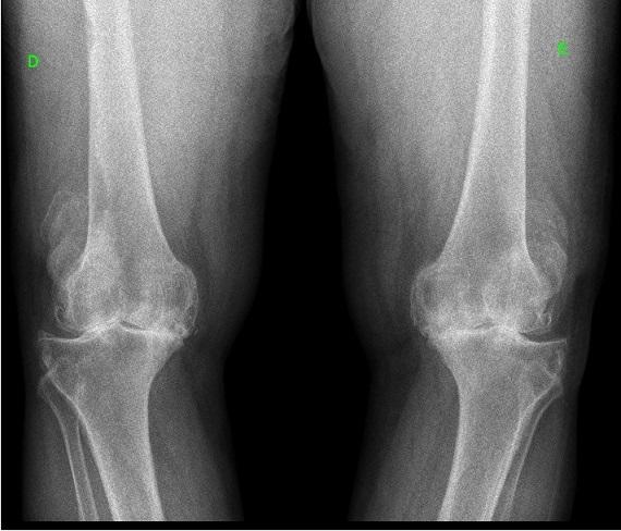 osteoartrite do joelho