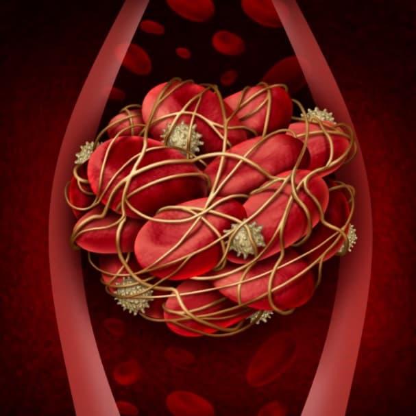 tromboembolismo venoso