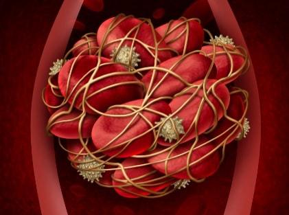 trombose da veia porta