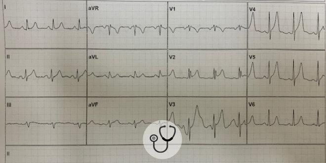 Caso clínico: ECG aponta sinais de sobrecarga de volume do VE