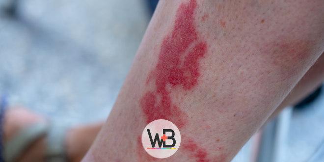 Doença de Kawasaki - whitebook