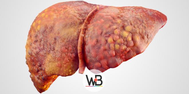 whitebook-esteato-hepatite