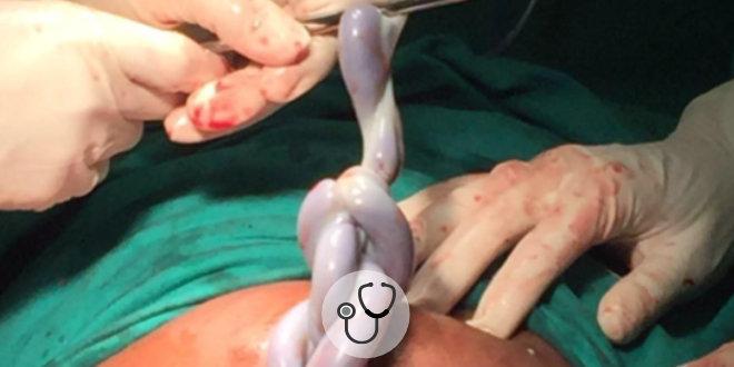 Caso Clínico: entrelaçamento de cordões em gestação monoamniótica