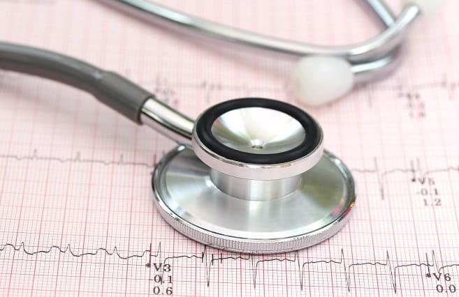 eletrocardiograma com um estetoscopio em cima mostrando extrassístoles ventriculares