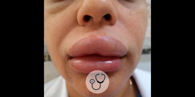 Caso clínico: mulher com edema labial e periorbital