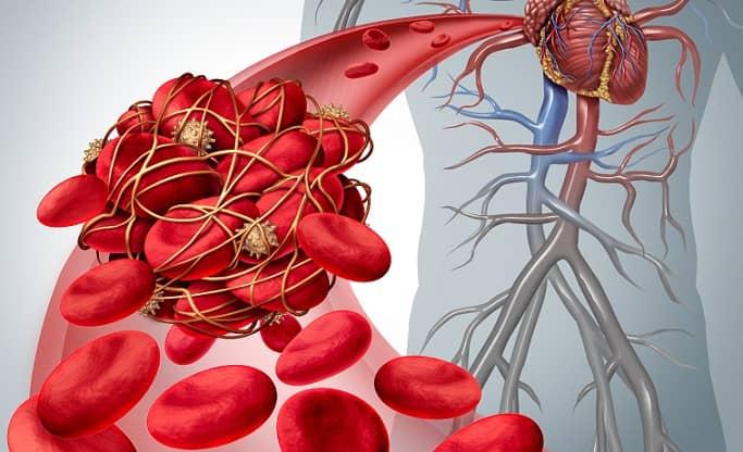 Coagulopatia na infecção por coronavírus: um fator de mau prognóstico