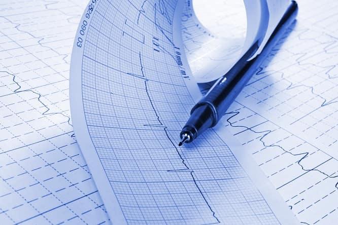 eletrocardiograma de paciente com insuficiência mitral, precisando de mitraclip