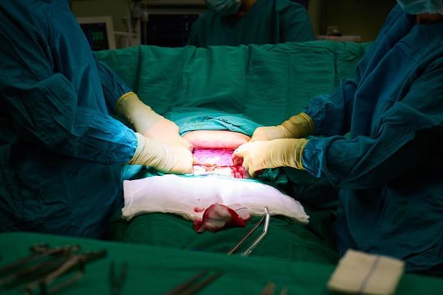 Grávida passa por cesárea em estudo sobre o uso de efedrina ou fenilefrina para hipotensão arterial