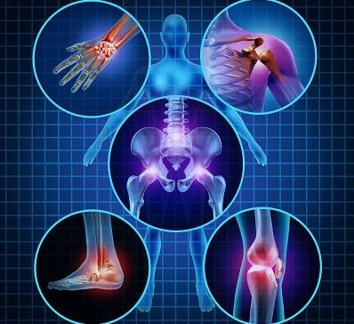 Representação de artrite reumatoide que pode estar associada ao tromboembolismo venoso