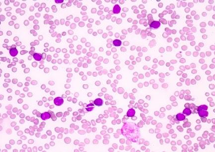 Transplante alogênico de células-tronco hematopoiéticas: prevenindo a GVHD aguda