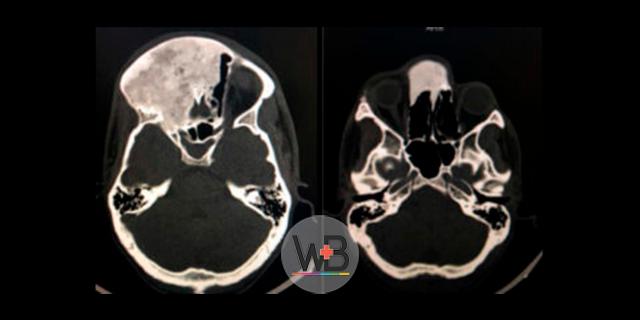 Em nossa publicação semanal do Whitebook Clinical Decision vamos falar sobre a abordagem inicial ao trauma crânioencefálico (TCE)