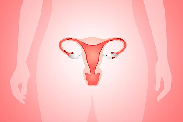 A Chochrane publicou uma revisão sistemática, comparando tratamentos da hiperplasia endometrial (HE )