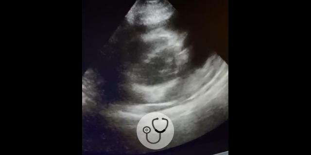 Caso clínico: paciente com dispneia progressiva aos esforços, qual o diagnóstico?