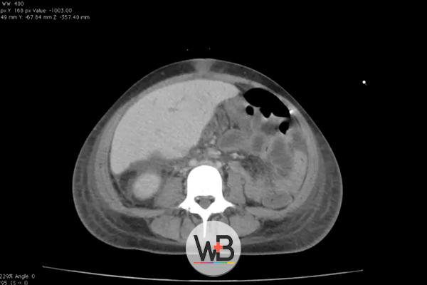 Em nossa publicação semanal de conteúdos do Whitebook vamos falar sobre a apresentação clínica da dor abdominal crônica em crianças.