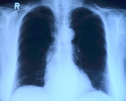 Tempo mínimo de tratamento para a pneumonia adquirida na comunidade: o estudo PCT
