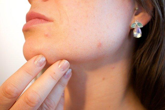 MELASMA: OPÇÕES TERAPÊUTICAS E DESAFIOS