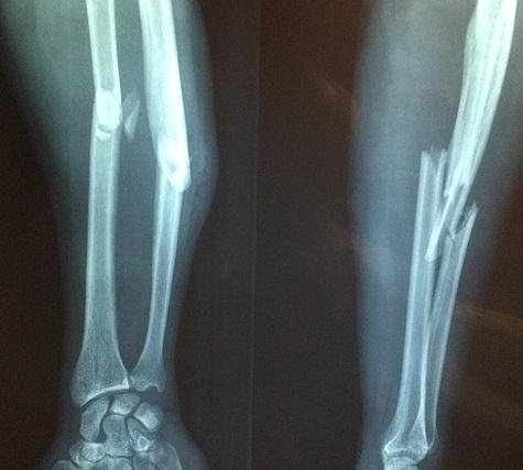 Fraturas traumáticas também estão relacionadas à osteoporose?