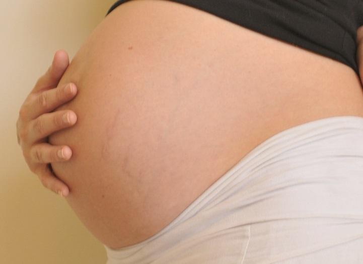 Gestantes com síndrome de Marfan: uma atualização sobre as complicações aórticas