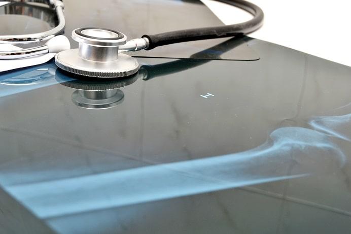 placas de minifragmentos utilizadas em cirurgias de ortopedia