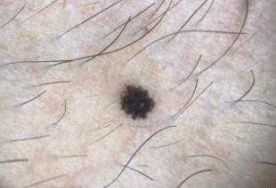 melonoma cutâneo