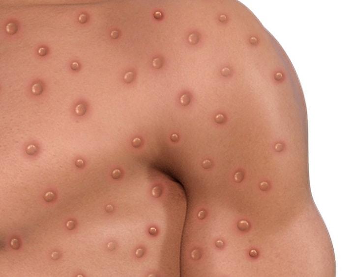 Monkeypox: autorizada a utilização emergencial de dois kits diagnósticos