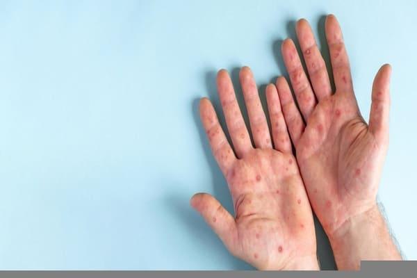 varíola dos macacos