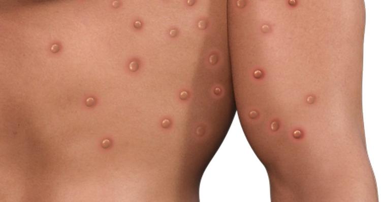 AIDS 2022 Infectologistas discutem epidemiologia, quadro clínico e tratamento de monkeypox