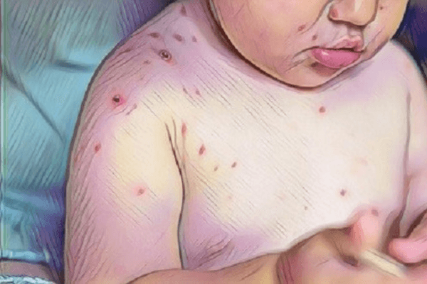 Aprovado registro do primeiro teste para diagnóstico da monkeypox no Brasil