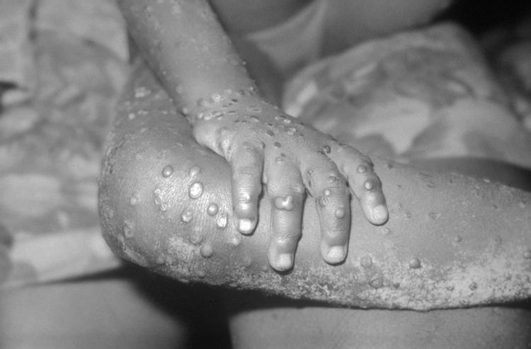 ID Week 2022: Monkeypox, como estamos?