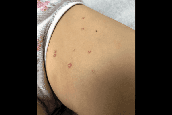 Whitebook – Molusco Contagioso