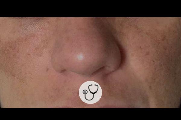 Caso clínico: Paciente de 38 anos com melasma