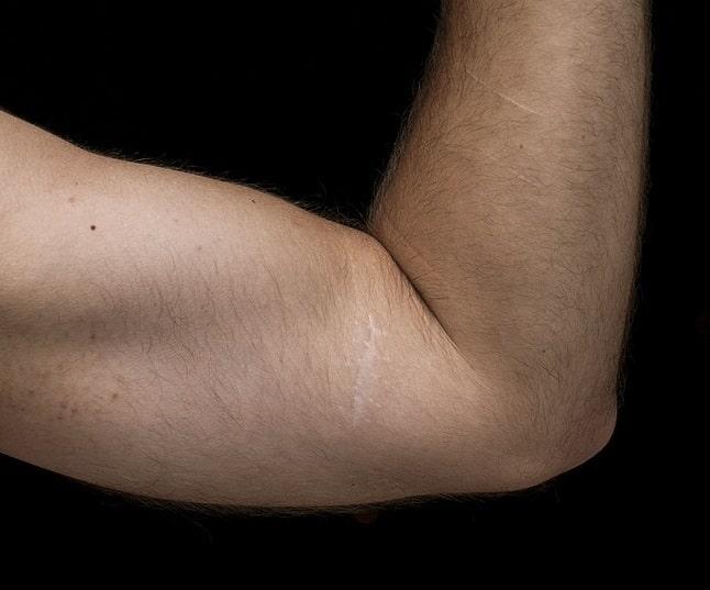 Qual é a taxa de revisão da artroplastia total de cotovelo